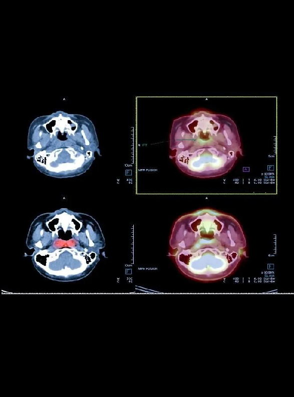 About PET-CT Scan