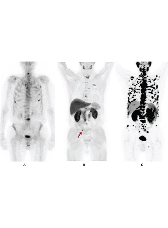 F18 PSMA PET Scan in Lucknow
