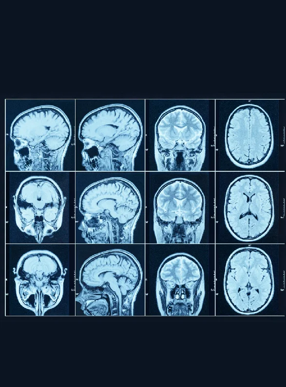 Brain PET scan